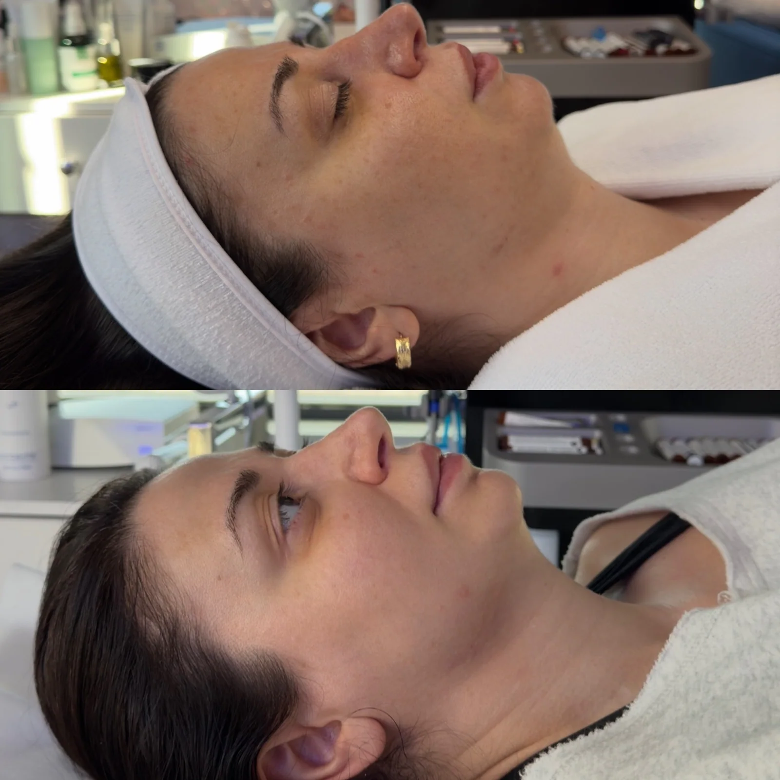 Before and after skincare result showing smoother-looking profile skin