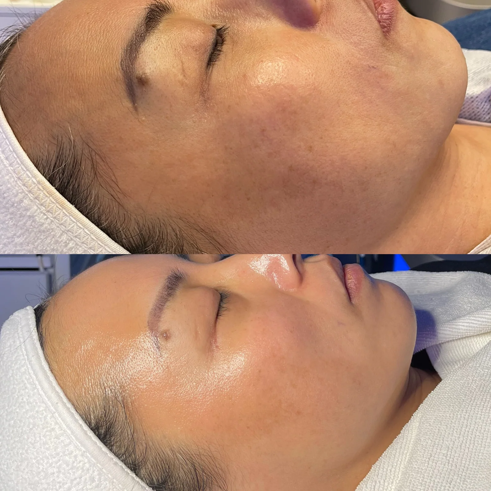 Before and after skincare result showing brighter-looking cheek skin