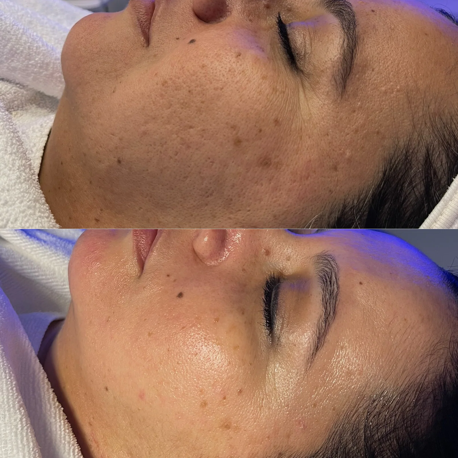 Before and after skincare result showing brighter, smoother cheek skin