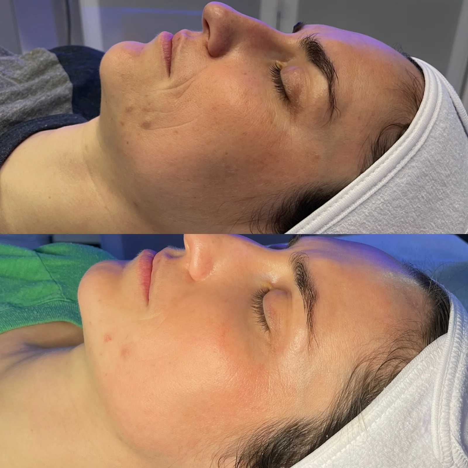 Before and after skincare result showing a clearer, calmer complexion