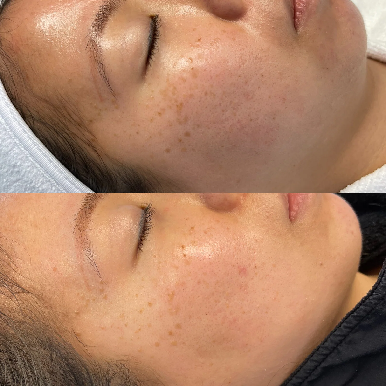 Before and after skincare result showing improvement in visible discoloration