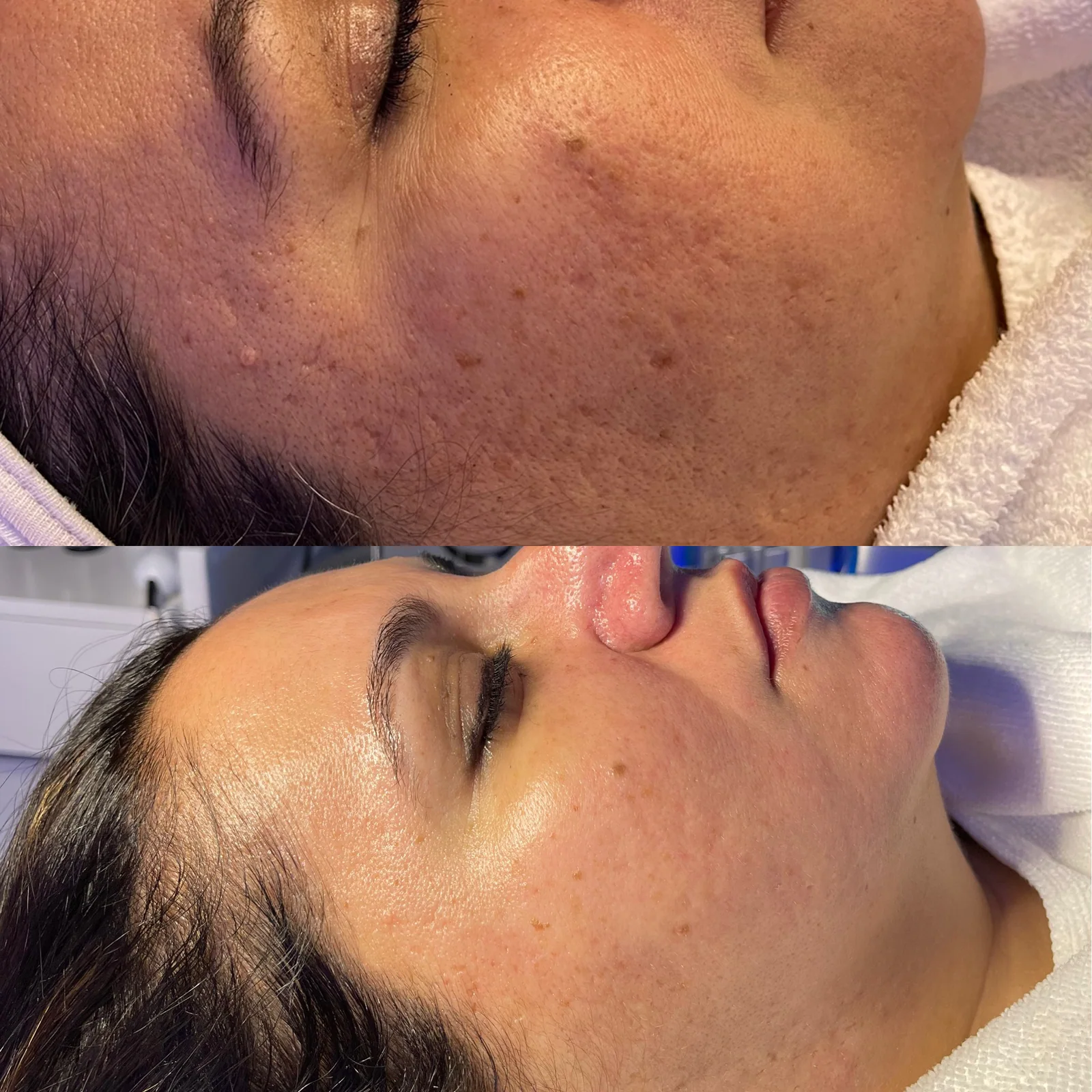 Before and after skincare result showing reduction in visible discoloration