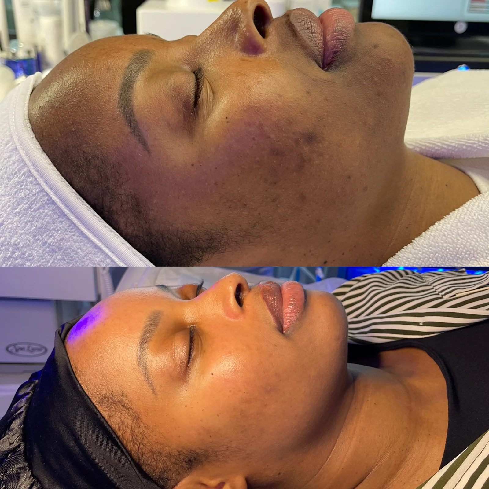 Before and after skincare result showing more even-looking skin