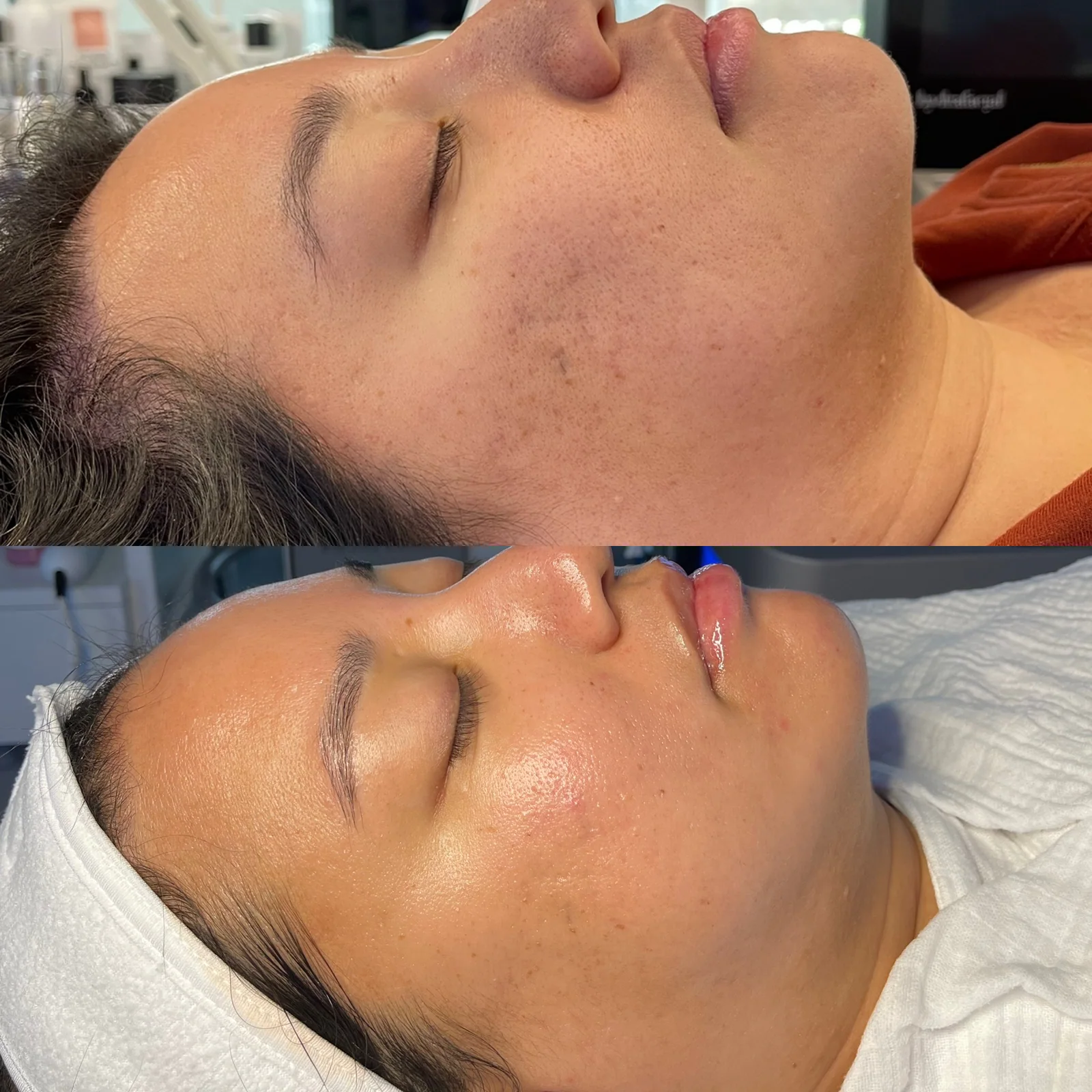 Before and after skincare result showing visible glow and reduced acne scarring