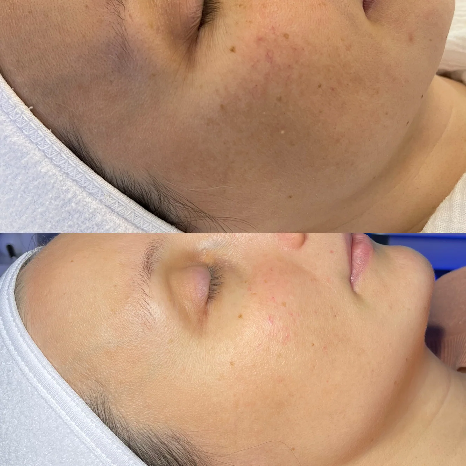 Before and after skincare result showing refined texture and tone