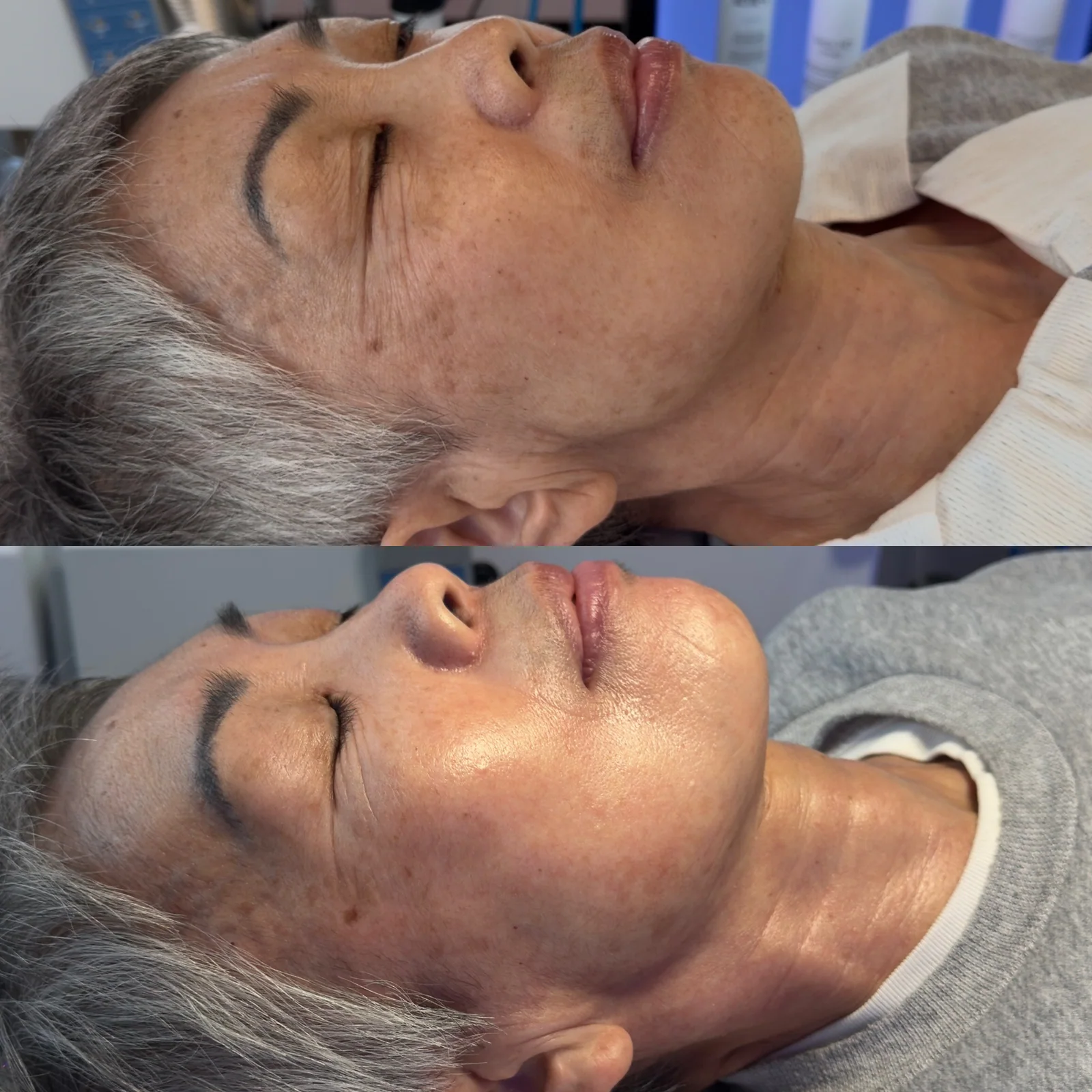 Before and after skincare result showing renewed glow and smoother tone