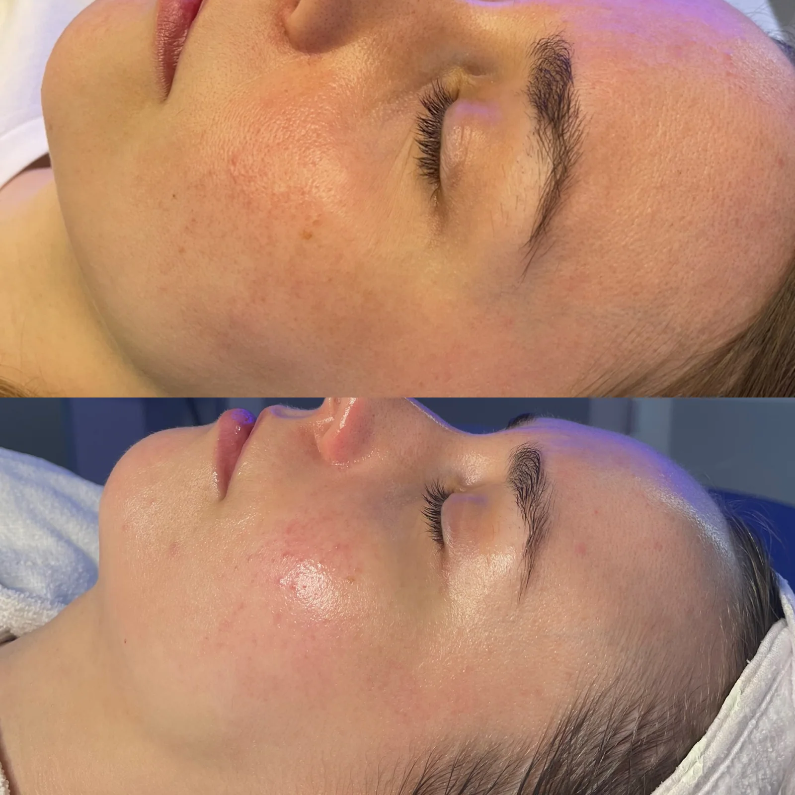 Before and after skincare result showing smoother skin texture