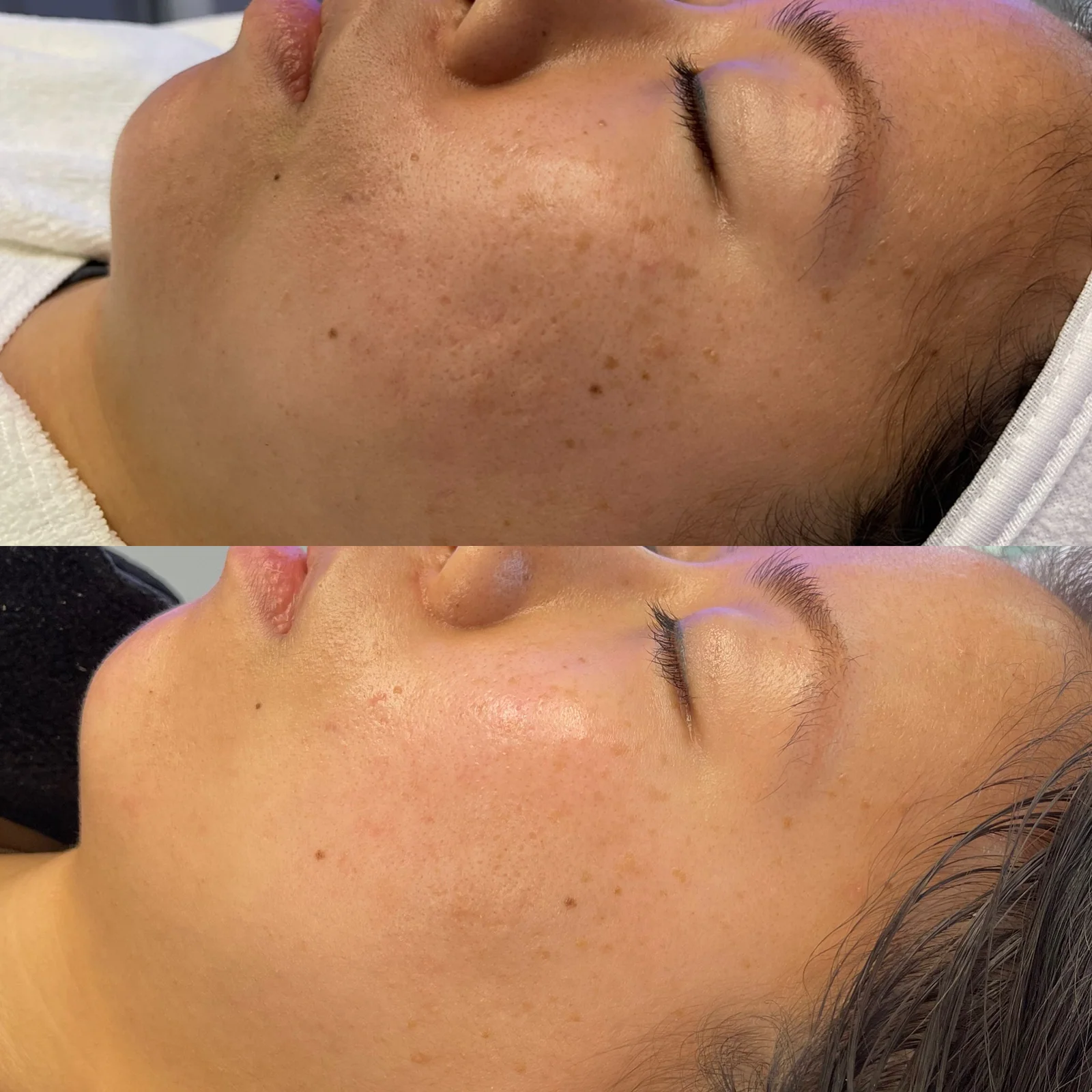 Before and after skincare result showing improved tone and clarity