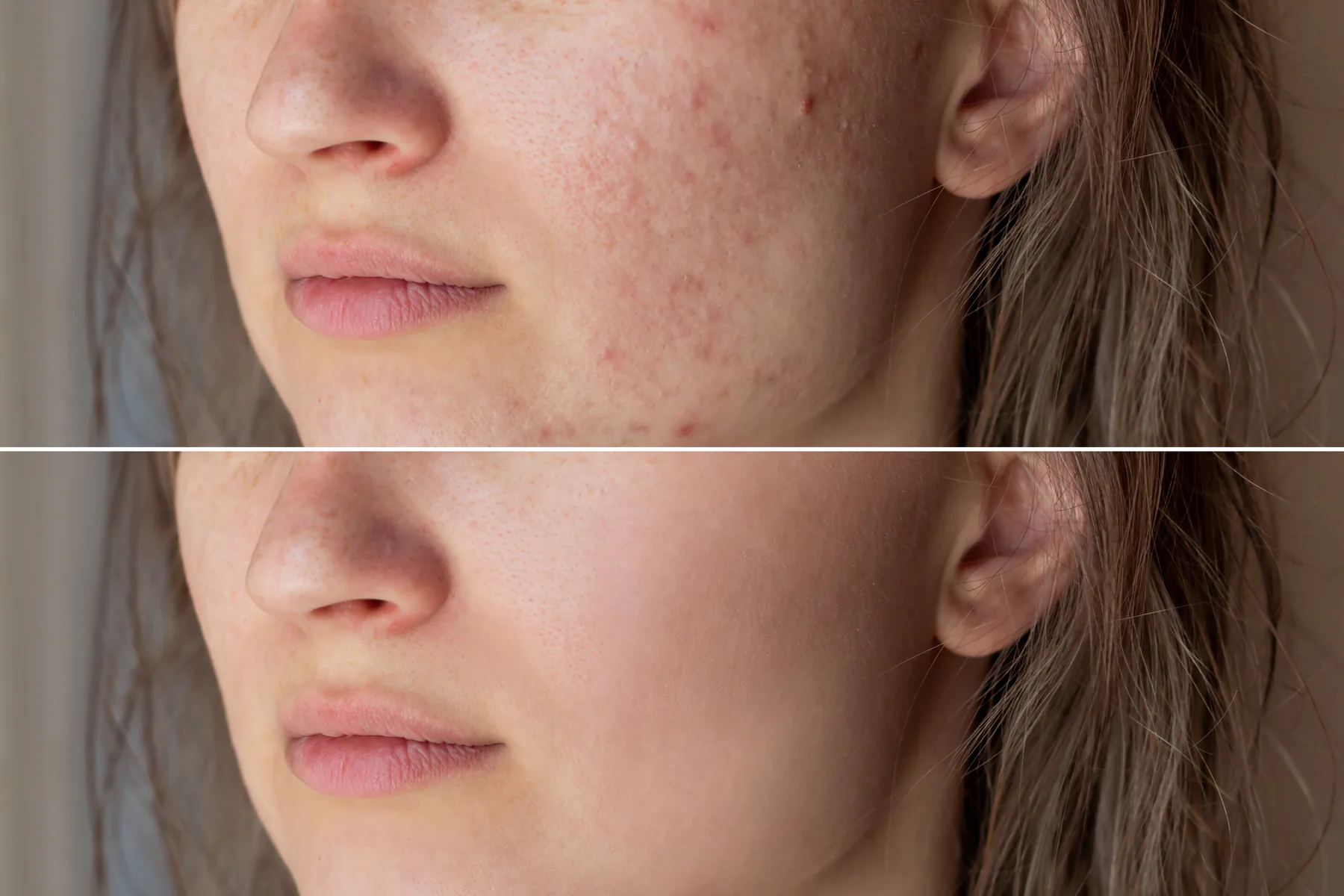Before and after acne facial results showing clearer skin