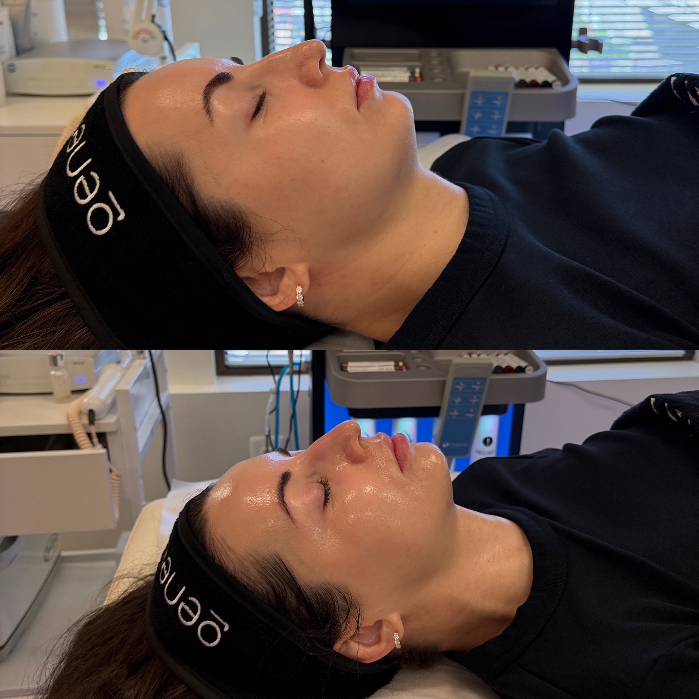 Before and after Glo2Facial result showing radiant glow and skin tightening