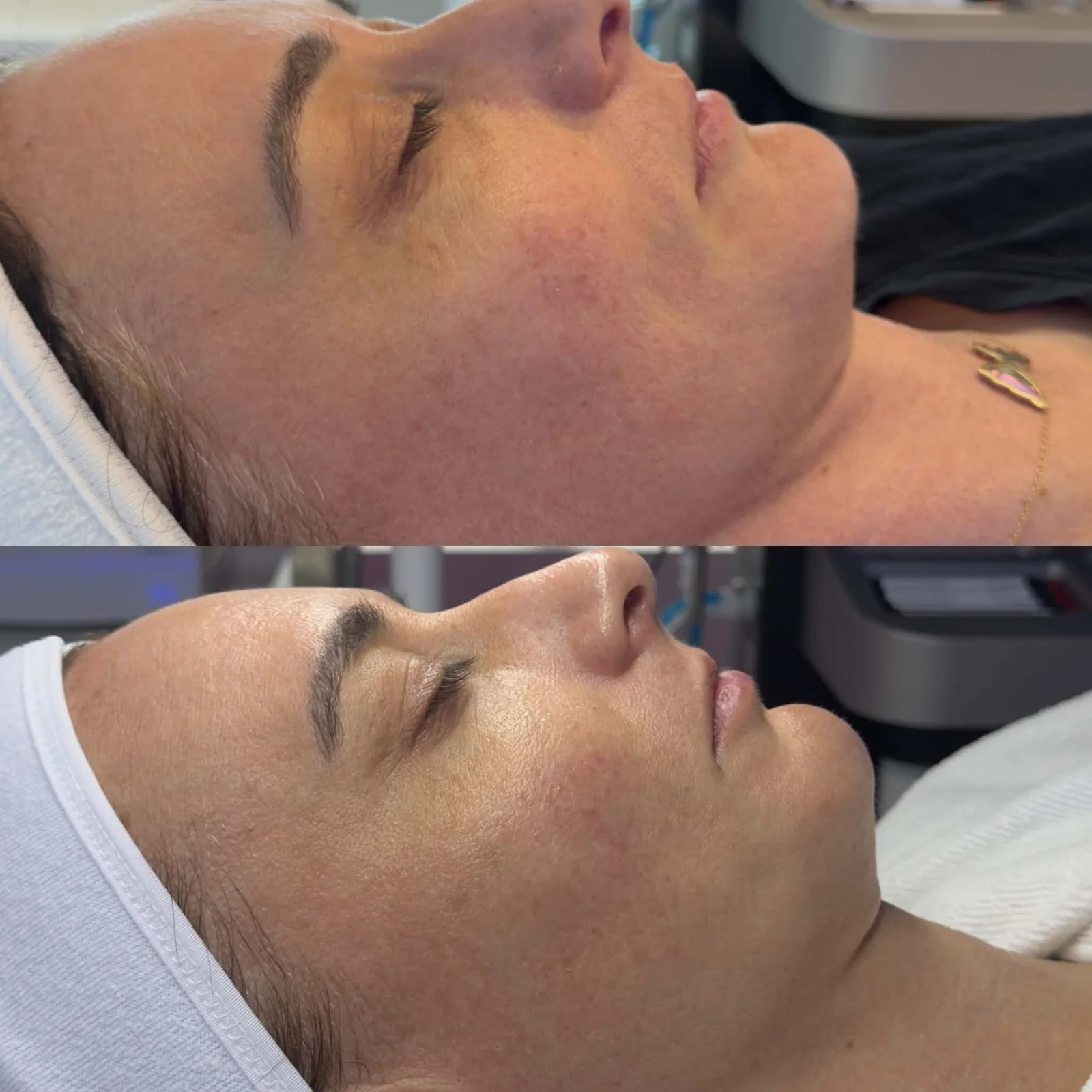 Before and after a series of three microneedling treatments showing tighter skin, softened fine lines, and improved texture and pigment