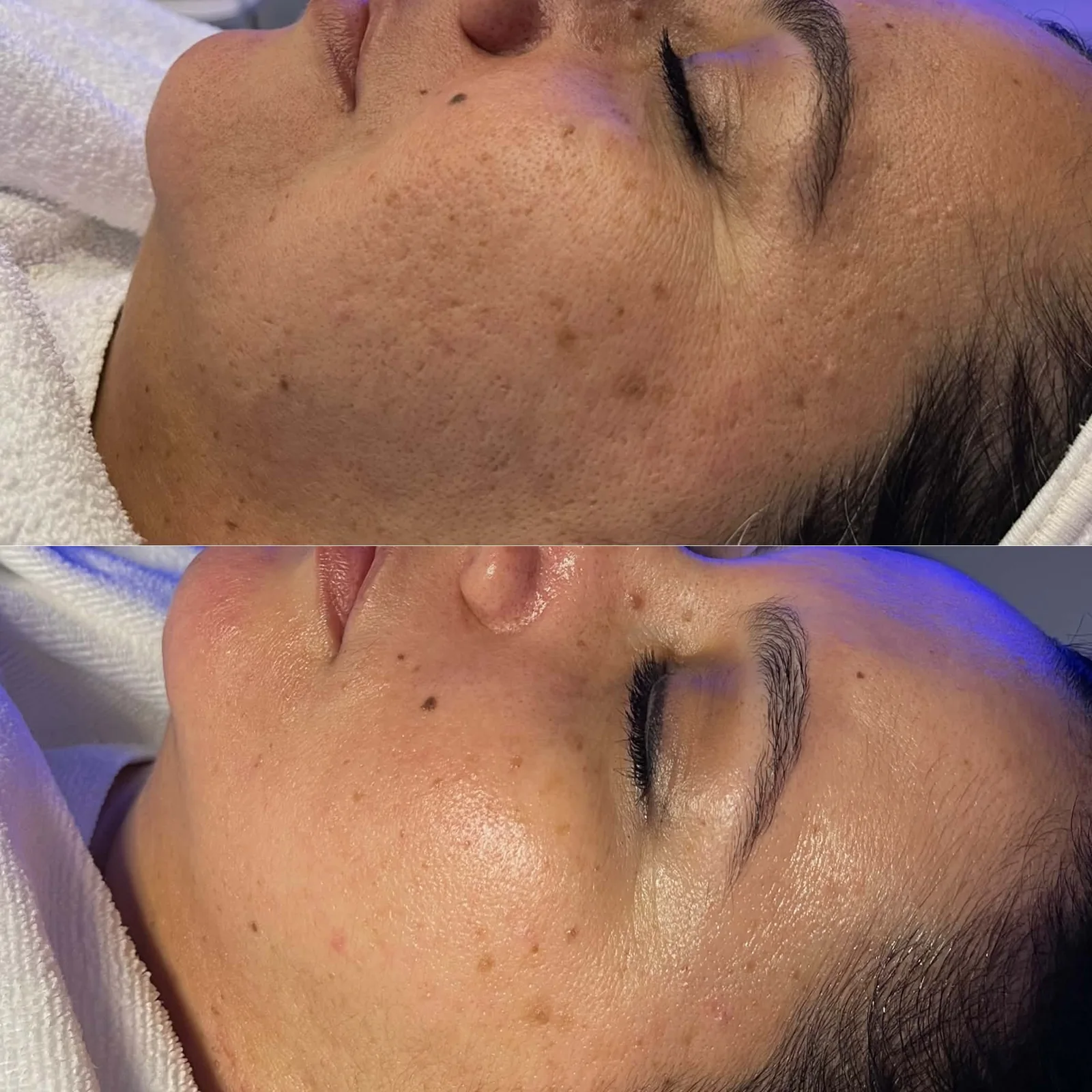 Before and after The Perfect Derma Peel showing brighter, more even-looking skin