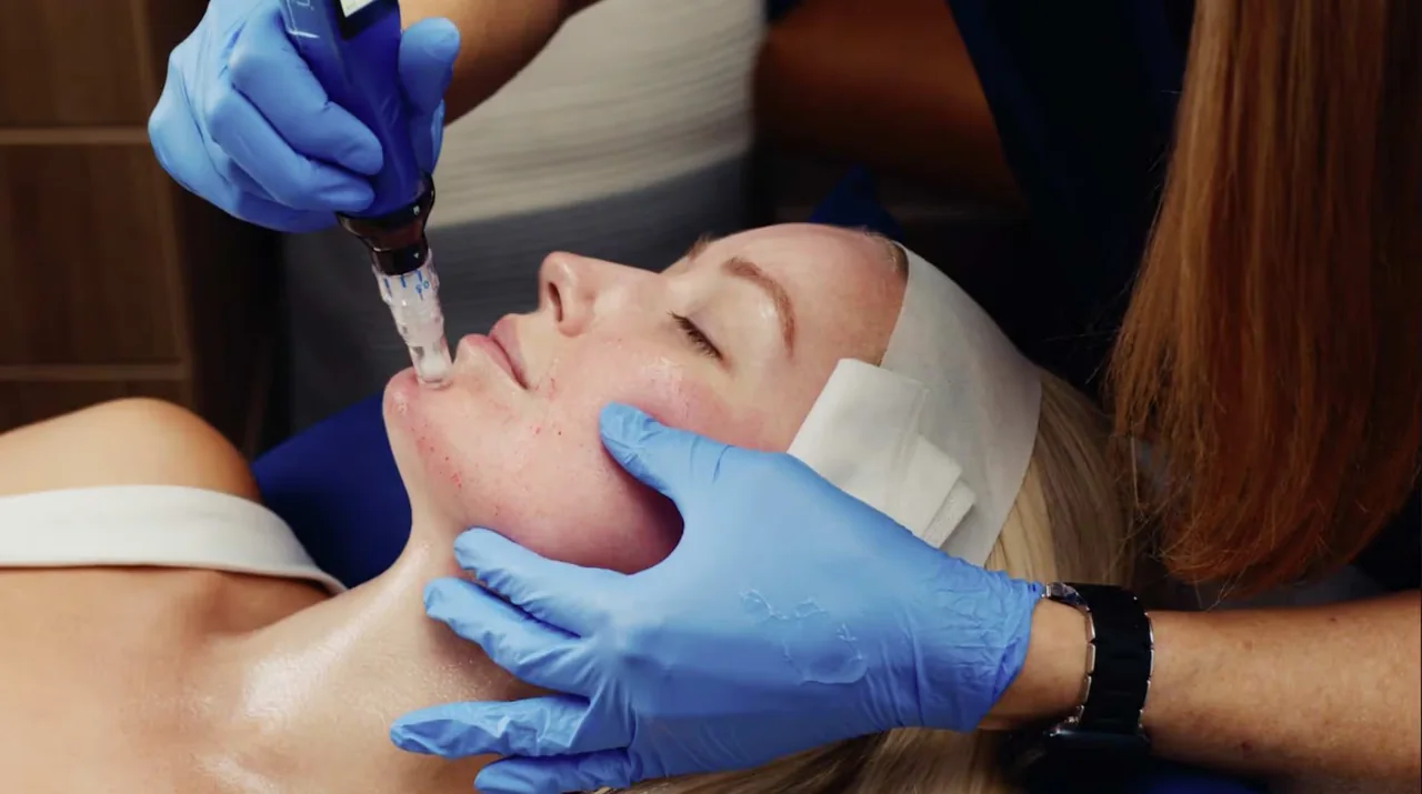 SkinPen microneedling treatment for acne scars and skin texture